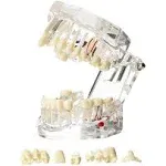 Dentalmall 1 PC Dental Oral Typodont Model Implant Pathological Anatomy Study Removable Teach Demo